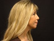 After neck lift