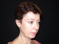 Before neck lift