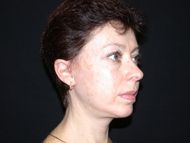 After neck lift