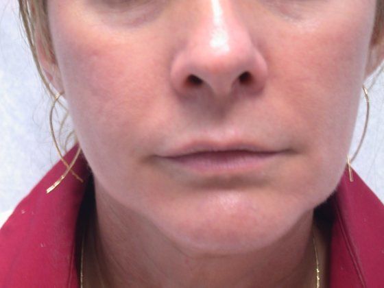 Before fillers