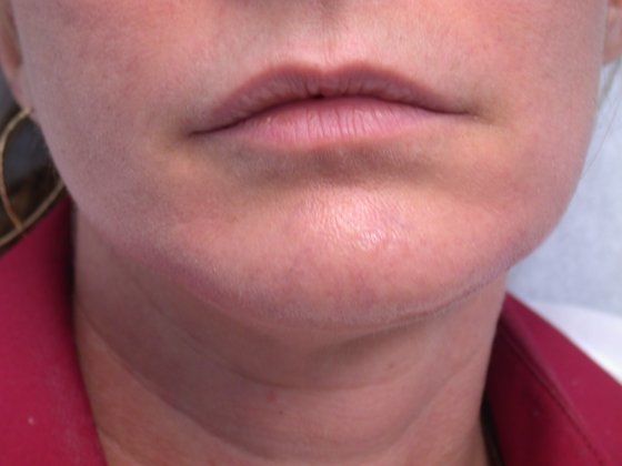 After fillers